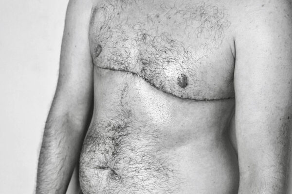 Dylan Thomas Cotter Top Surgery Healing